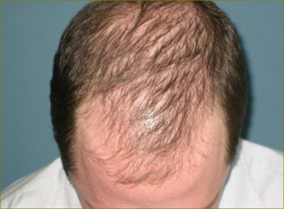Androgena alopecija