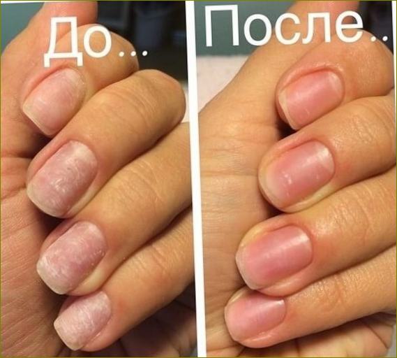 Jačanje noktiju biogelom prije i poslije