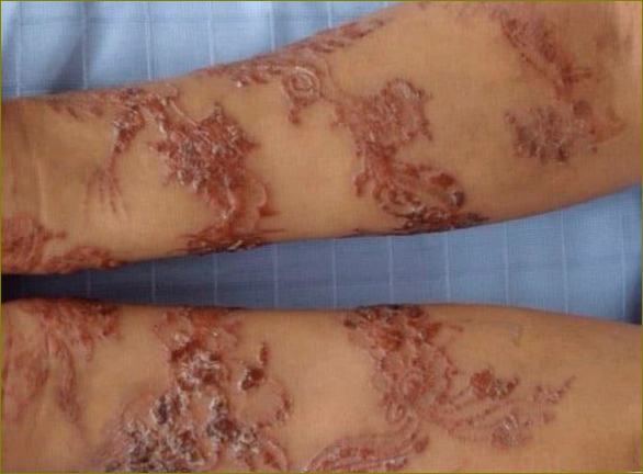 Alergija na tetoviranje kane
